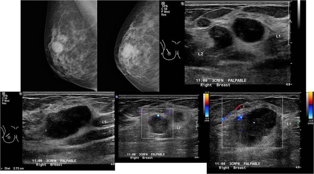 Fig. 12: A patient with a palpable right breast lump. Mammogram MLO and CC views show overlapping ovoid opacities in the right upper outer quadrant.
