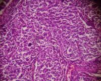 Figure 1: Photomicrograph showing infiltrating ductal carcinoma (H & E,10 x 10X) Figure 2: Photomicrograph