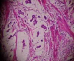 figures IN infiltrating ductal carcinoma (H & E,40 x 40X) REFERENCES: 1 Jemal A,Murray T,ward E,Samuels