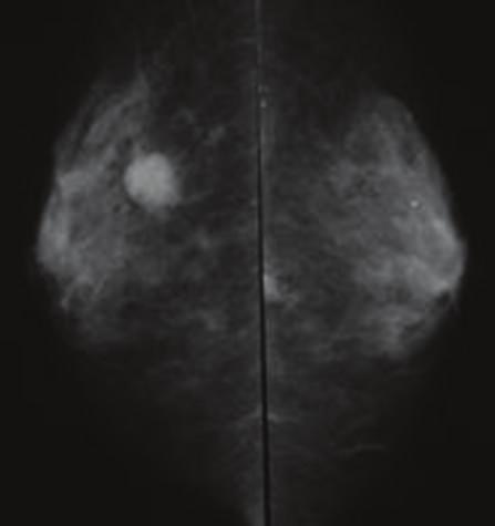 2 Case Reports in Surgery (b) (c) (d) (a) (e) (f) (g) (h) (i) Figure 1: Mammogram showing a round, high-density mass in the right breast ((a), arrow).