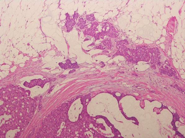 Palisading of tumor cells was evident around the fibrovascular cores.