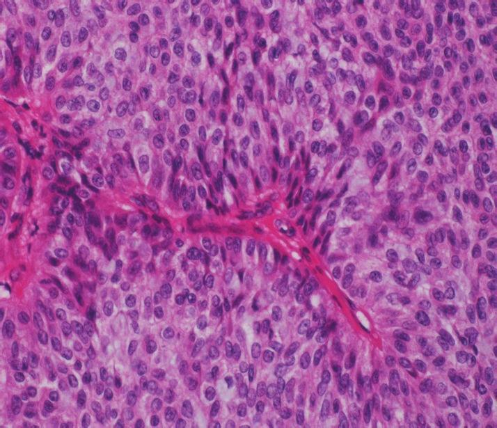 Mucicarmine staining demonstrated mucin in the gland lumens and cytoplasm of the tumor cells (hematoxylin-eosin, original magnification 40).
