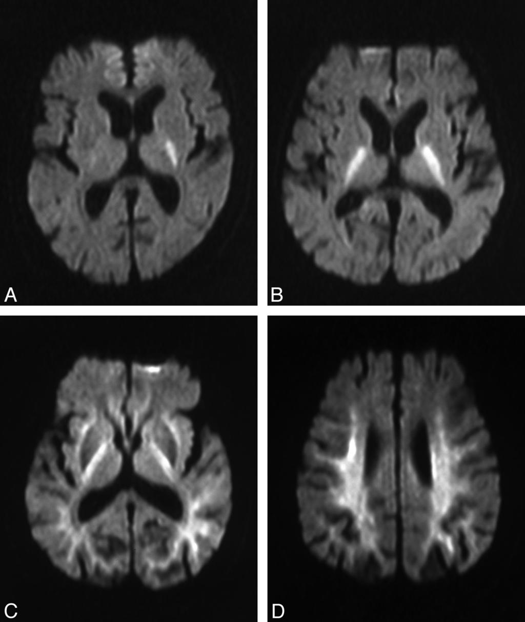 Fig 1. Two different DWI lesion patterns in patients with hypoglycemic coma are indicative of 2 different outcomes.