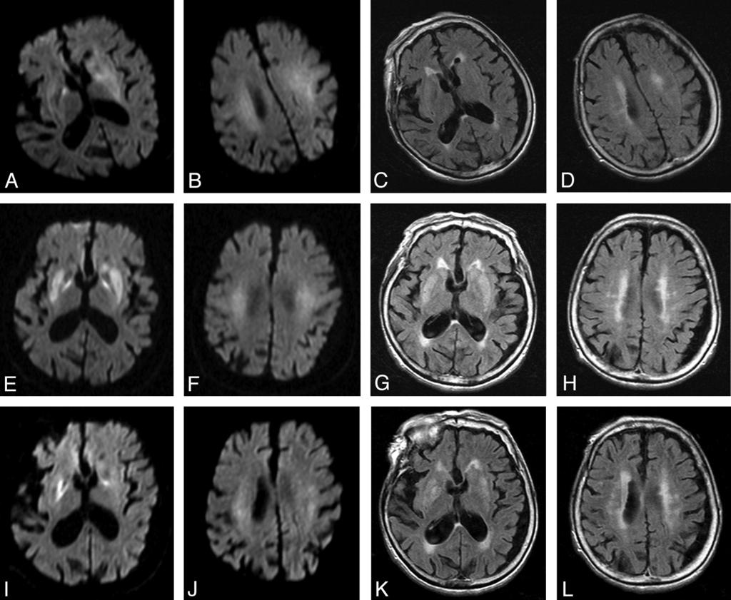 Fig 3. Follow-up images of hemispheric white matter and basal ganglia lesions on DWI (A, B, E, F, I, J) and FLAIR (C, D, G, H, K, L) (patient 21).