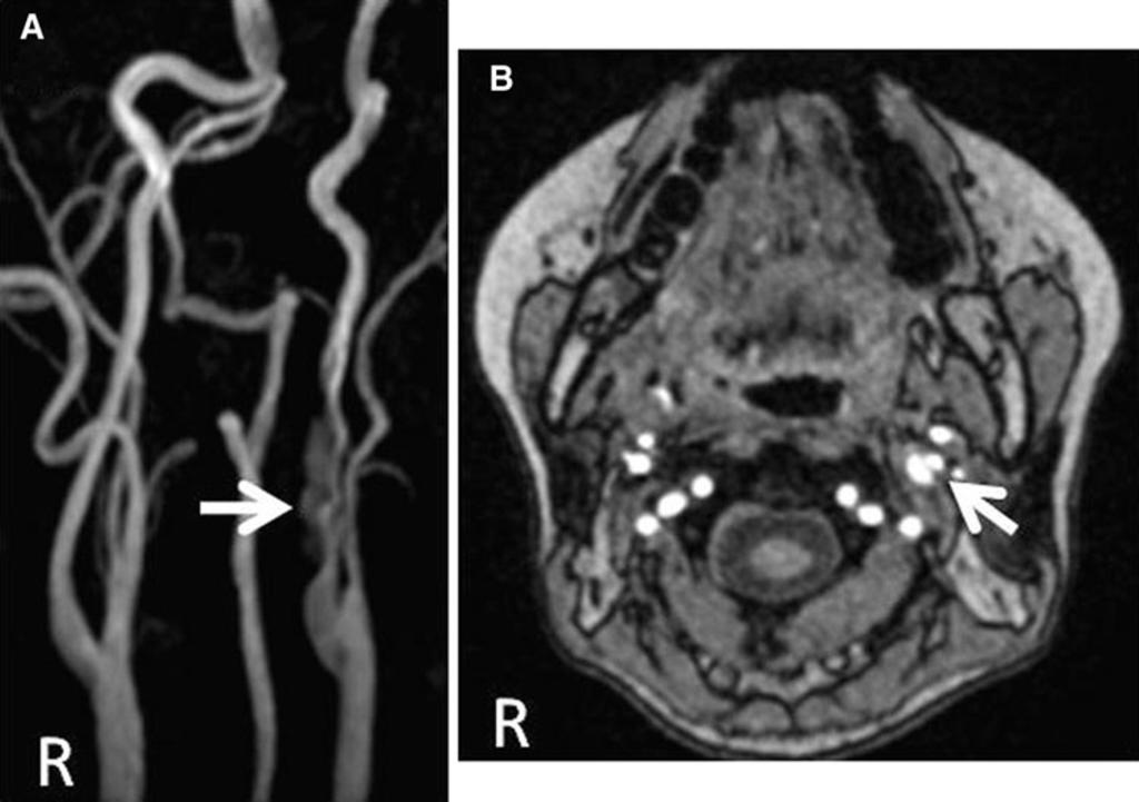 2 MRA and MRA source image findings in internal carotid artery dissection (case 6). a The string sign is visible in the left cervical internal carotid artery on MRA.