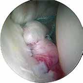 An arthroscope, or small camera, is inserted through one of the incisions to view the joint, and in particular the damaged capsule and the ligaments.
