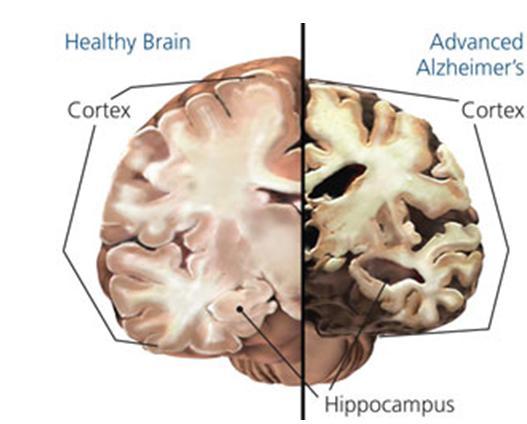 Pathology Alzheimer Disease 30-50% gait disorders Impaired brain structures