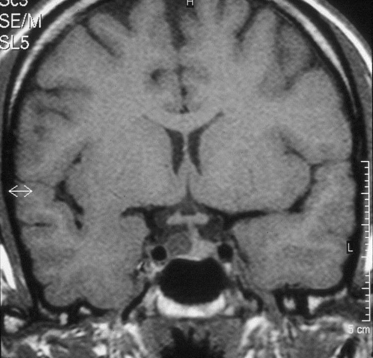 Pituitary MRI scan showing a