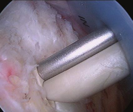 Position the Sheath in the tunnel so that the compressed profile is adjacent to the tendon.