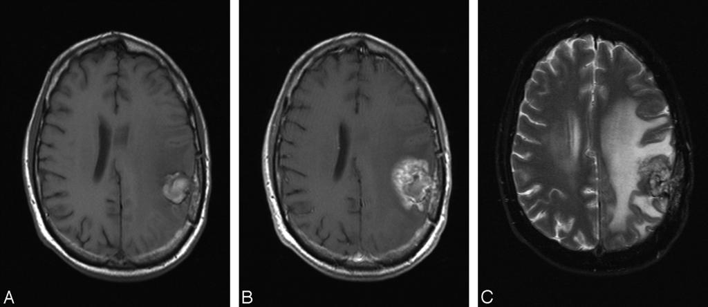 Fig 1. A, Axial noncontrast T1-weighted MR image obtained 18 months after resection and radiation of an anaplastic astrocytoma presenting with a hemorrhagic lesion in left parietal region.