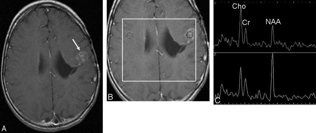 C, Axial T2-weighted MR image shows the extensive edema surrounding the lesion in the left hemisphere. Fig 2.