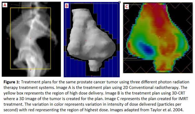 2.14 Image Guided Radiation Therapy (IGRT) In IGRT, throughout the course of treatment, imaging scans from either CT, MRI, or PET are repeatedly collected.