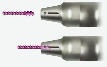 10 IMPLANT ORIENTATION The 10 implant must be inserted in the direction shown on the side of the driver when placed correctly, 10 IMPLANT ORIENTATION the proximal side of the implant will be