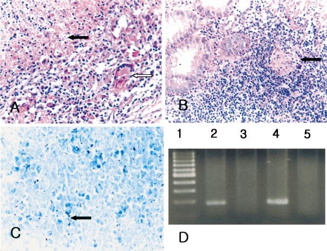 A, Typical histopathologic features of tuberculosis of the lung in a patient in the present study, which were a well-formed granuloma with caseous necrosis (black arrow) and Langhans-type giant cells