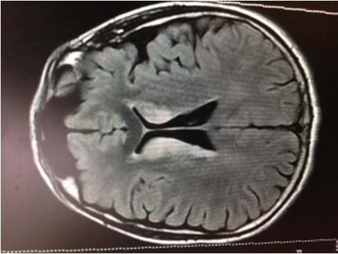 Case: HIV+ man with abnormal MRI MRI done after fall