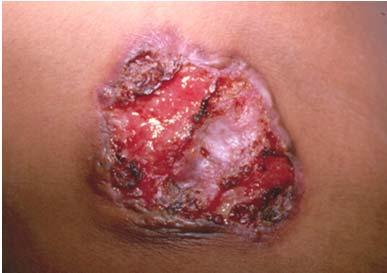 Dermatologic TB May be hematogenous or direct spread May be injection: accidents