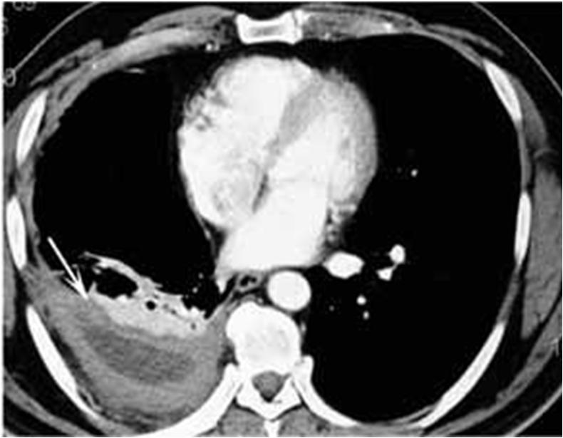 TB Empyema Diagnosis Thoracentesis with pleural biopsy 30% yield for MTB from pleural fluid Exudative fluid with