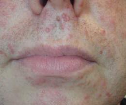 A 40-year old male with follicular papule
