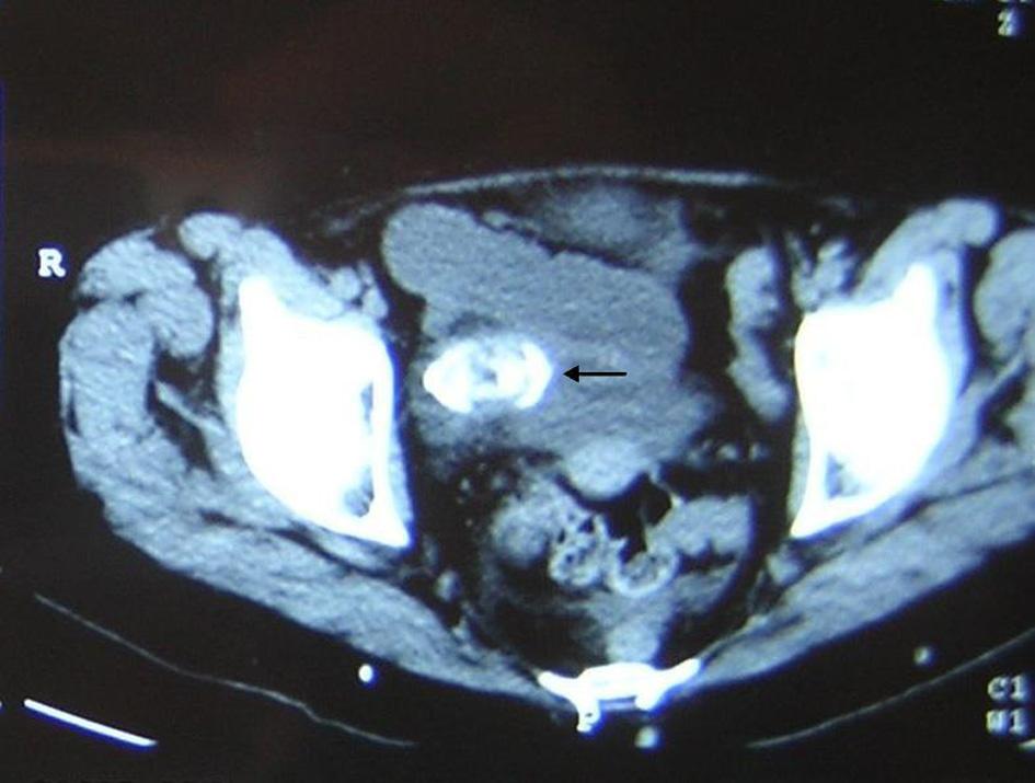 Gallstone Ileus Figure 1. Abdominal tomography shows ectopic stone in the ileum. score), preoperative findings, duration and type of surgery, post-operative outcome, 30-day mortality.