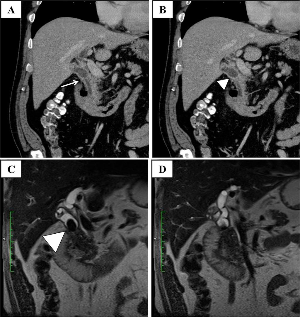Kawaguchi et al. Surgical Case Reports (2015) 1:51 gallbladder with the bile duct (Fig. 1) suggesting MS with BBF.