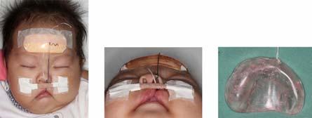 In order to prevent further nasal collapses from scar contraction after surgery, nasal molding should be continued to maintain nasal position.