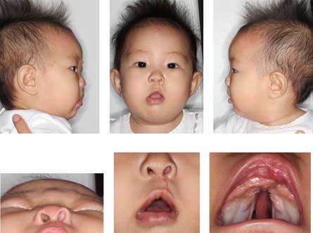 (14,15). Fig. 12 Fig. 13 Fig. 14 The extra- and intra-oral appearance after one week of lip repaired. The extra- and intra-oral appearance at seven weeks after lip repaired.