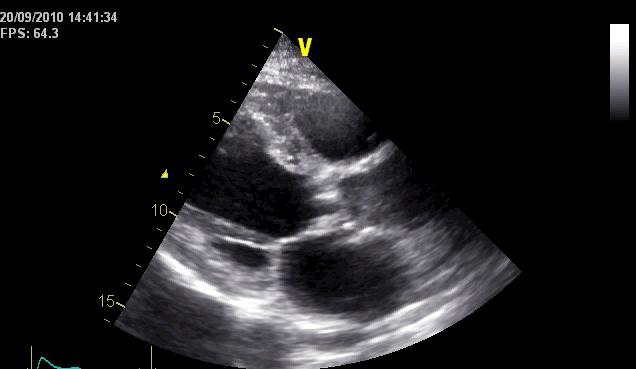 incidental finding on echocardiography (3) Echocardiography