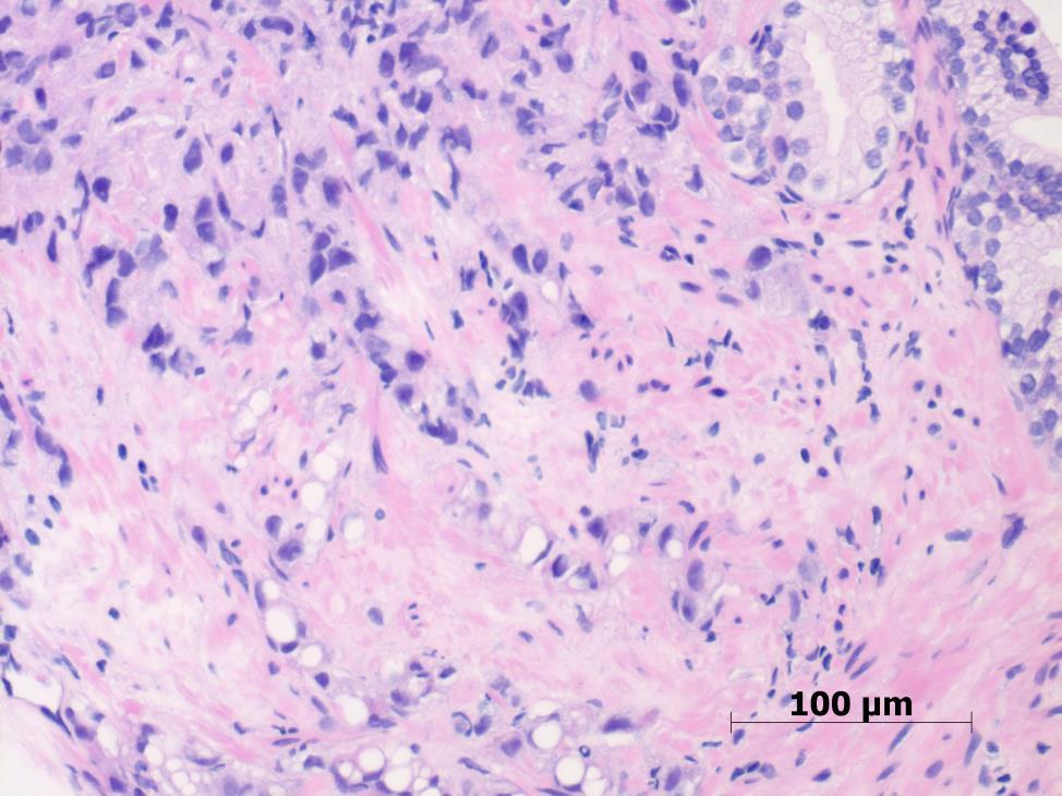 Figure 1 Gleason grade 5 carcinoma Table 2 Gleason scoring of unusual patterns Pattern Morphology Comment Vacuoles Cytoplasmic change seen in all grades Grade as if vacuoles were absent, on the
