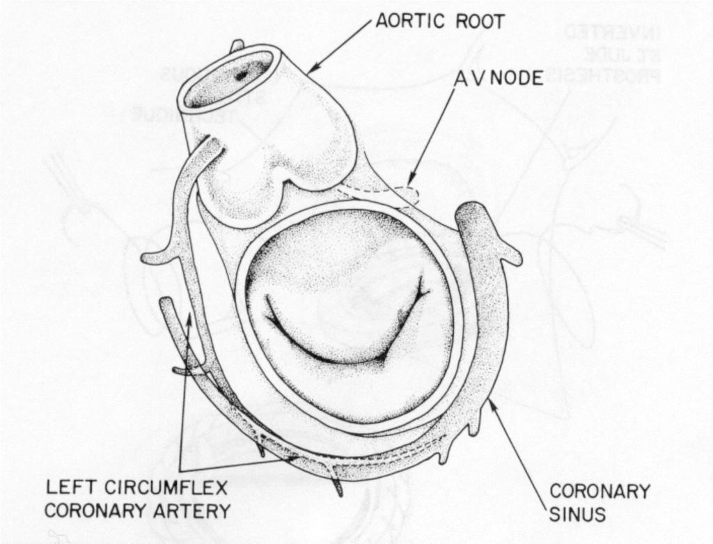 Mitral Anatomy Subaortic curtain Aortic leaflets AV node position Coronary Sinus Circumflex