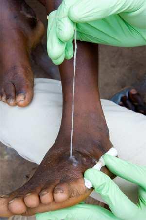 (river blindness) Schistosomiasis Soil-transmitted
