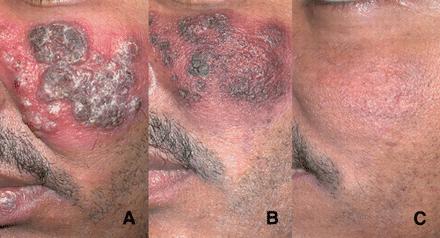 Treatment of cutaneous leishmaniasis before (A), 3 weeks (B), and 12