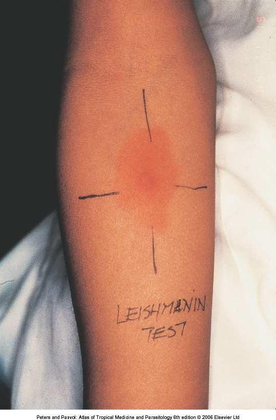 Leishmanin (Montenegro) test Intradermal injection of an antigen from cultured promastigotes