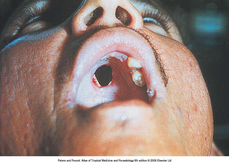 Mucocutaneous leishmaniasis leads to destruction of mucous membranes: nose, mouth and throat clinically evident within several years of the original cutaneous lesions parasite spread from the skin