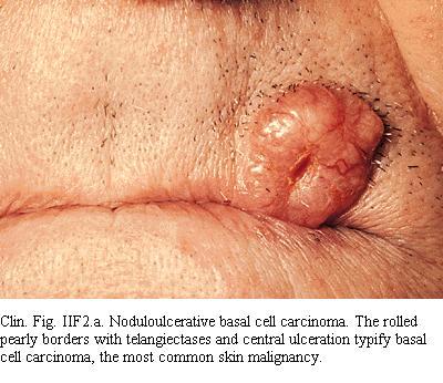 Nodular Basal Cell Carcinoma Hair bearing skin More than half of BCCs are nodular