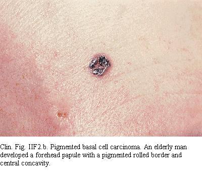 Pigmented BCC Brown eyed individuals and others