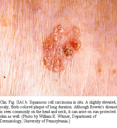 Squamous Cell Carcinoma in Situ Clinically Sharply