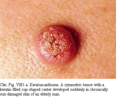 Squamous Cell Carcinoma (Keratoacanthoma Type) Symmetric, red nodule with ulceration centrally Low