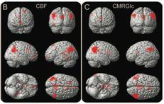 Neuroimage 2008;42:1267 Comparison of ASL with FDG-PET! 15 AD vs 19 controls.