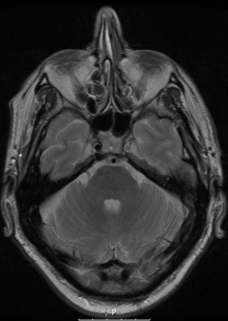 multiple lacunar infarcts carotid occlusion frontal and parietal