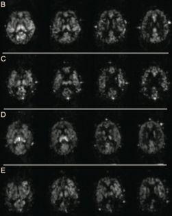 Neurology 2011;76:1478 control AD AD: parietal & prefrontal cortex post-stroke no dementia post-stroke: global