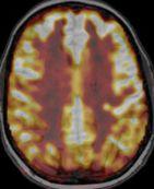 ASL&MRI&(24;05;2011)& C/Normal+ Normal&L&temporal&lobe& Normal&posterior&cingulate& Diagnosis&