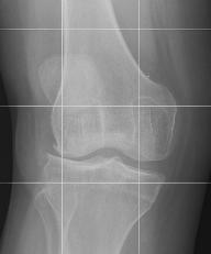Articular cartilage lines the bony joint surfaces and allows Knee Joint with No the joint to move in a near frictionless environment.