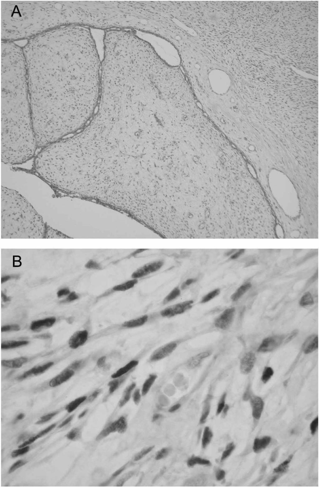 174 S.V. Harden et al. Fig. 1. The borderline phyllodes tumour of the breast. (A) H&E-stained section; (B) p53-immunostained section showing strong nuclear staining of the stromal cells.
