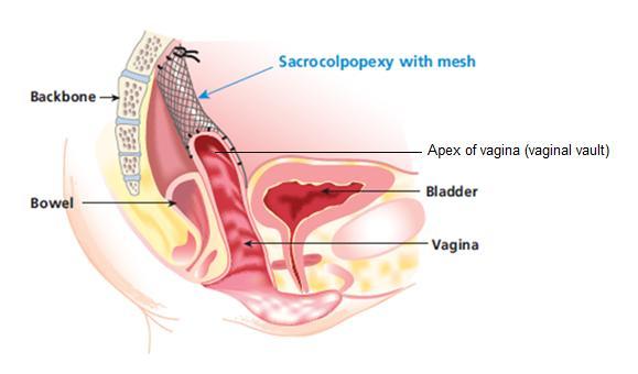 What is a Sacrocolpopexy A sacrocolpopexy is an operation to treat a prolapse of the vaginal vault (top of the vagina/front passage) in women who have had a hysterectomy (removal of womb) using a