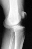 Anterior Knee Dislocations Most common