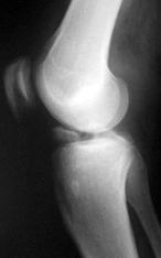 Imaging RADIOGRAPHS May be normal if spontaneous reduction Irregular joint space Avulsion fractures Osteochondral defects MRI Required to define soft tissue injuries Algorithm Summary Clin J Sports