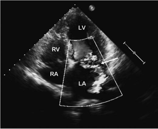 Aortic Stenosis (AS) Physical Exam: Arterial pulse is less pronounced on carotid pulse Crescendo-decrescendo systolic murmur Chest Radiography: Relatively normal with cardiomegaly in late stage AS