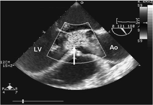 Aortic Regurgitation (AR) Physical Exam: Widened pulse pressure due to elevated SBP and depressed DBP Diastolic decrescendo murmur; shortens with severity Chest Radiography: Some pulmonary congestion