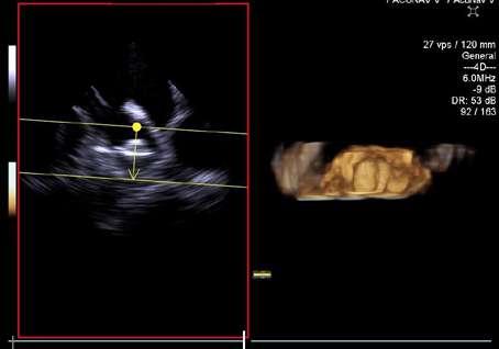 2D TEE Mitral valve imaged with the Z6Ms True Volume
