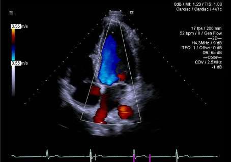 3D TEE Mitral valve imaged with the Z6Ms True Volume